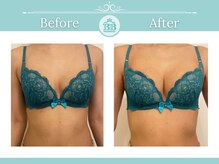 美人バスト 表参道店/【バストアップ/育乳 症例】