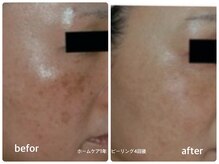 エミー(emy)/江坂/毛穴/ハーブピーリング