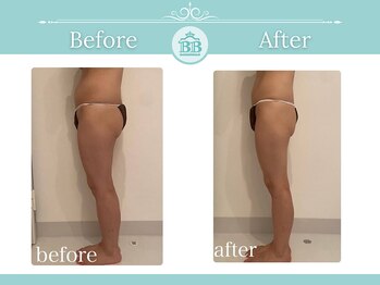 美人バスト 犬山店/【下半身ダイエット】症例♪