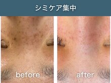 シアラ(SHIARA)/シミケア後の変化