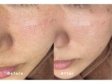 ハーブピーリングで毛穴が目立ちにくくなります！