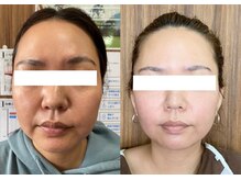 ルポ 那覇(repos)/電気美容鍼