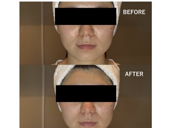 サロン リノ(salon rino)/【韓国小顔】メシダ脂肪分解