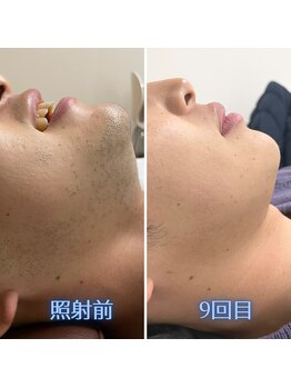 ナウザ 高崎店(NAUZA)/青ヒゲを卒業!ビフォーアフター