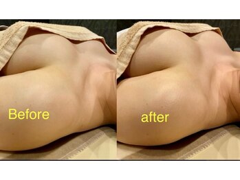 ベッピン(Beppin)/ブライダルまでに最高に綺麗に♪