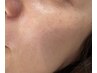 マリムーブフェイシャルwax脱毛
