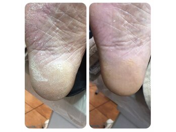 事例【ドイツ式フットケア】