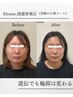 【エラ頬/歪み/面長/輪郭矯正】美人黄金比★長年の悩みループから解放！