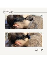 ラグレ(LUXRE)/うなじ脱毛