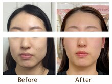 ビーレ袋町/[小顔矯正]首歪み・エラ張りも