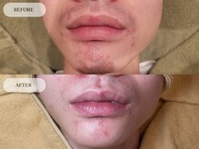 メンズプラス(MEN’S PLUS)/ヒゲ脱毛/ビフォーアフター写真