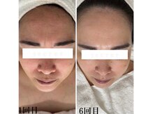 プラセル(Placer)/土台から整える