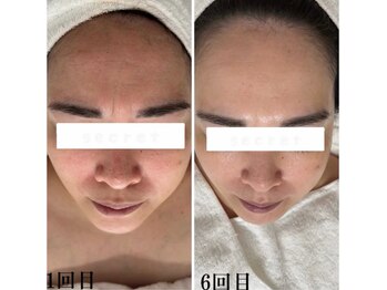 プラセル(Placer)/土台から整える