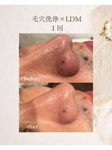 フォルディオ(FORDIO)/毛穴洗浄×LDM
