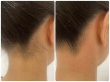 ウェイビーズ エステ(wavy's.esthetic)/【ビフォーアフター】うなじ脱毛