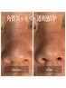 口コミ特典【最強美肌Set】光フェイシャル×ハーブピーリング￥9900→¥8800