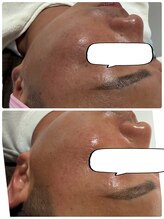 ココサロン(Coco Salon)/塗るボツリヌストキシン