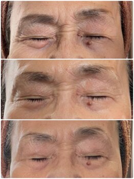 リラクゼーションサロン ラキ(laki)/ネオピール/ピーリング