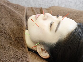 ソリーシェ鍼灸院(SORRISCE)/美容鍼灸もお任せください★