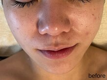 サロン ド エメ(salon de aimer)/【Before】赤み、毛穴に♪