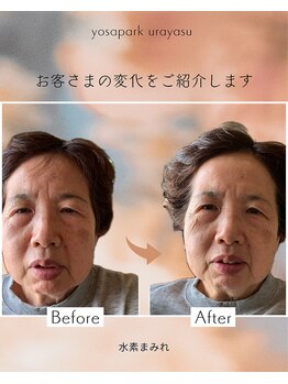 ヨサパーク ゴールデンツリー 浦安本店(YOSA PARK GordenTree)/水素まみれでリフトアップ↑↑