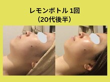 アユアラングレース/レモンボトル2回