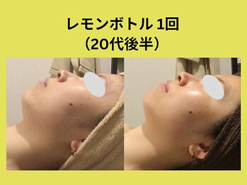 アユアラングレース/レモンボトル2回