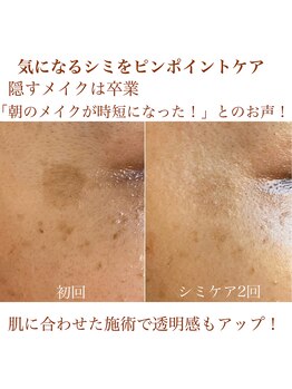 カミーシャ(KaMi-Sha)/シミケアで隠すメイクは卒業！