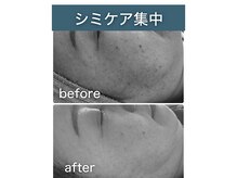 シアラ(SHIARA)/シミケア後の変化