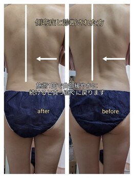 紬(TSUMUGI)/腰痛の原因、背骨の歪みも