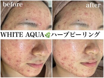 アワピール 天王寺店(AWA PEELL)/ハーブピーリング/ニキビケア