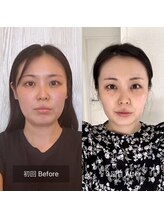 ハッピービューティーサロン じゆう(Happy Beauty Salon J∞YOU)/人気No.1/魔法の小顔矯正/3回目