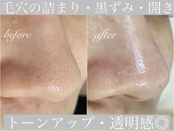 アリスビューティー(AliceBeauty)/大人気の毛穴引き締めコース