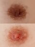 【ピンクスキン】バスト(乳輪乳頭)１名限定！アフタークリーム付き￥90,000→