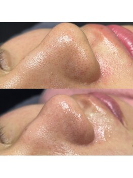 ニューフェイス(NEW FACE)/毛穴洗浄