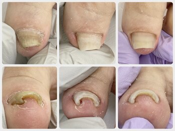 爪処 中野坂上/巻き爪ケア