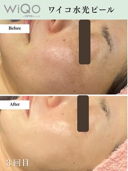 ソーヴ(SOLVE)/ワイコ水光ピールでツヤハリ感★