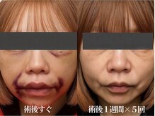 術後インディバ専門サロン 新宿/切開リフト/輪郭3点/インディバ