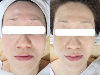 soin＋【ソワンプラス】の写真/【ほうれい線・リフトアップ】本気のリフトアップ！お口周りの悩みを徹底ケア！シワ／たるみ／ほうれい線に