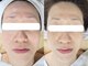 soin＋【ソワンプラス】の写真/【ほうれい線・リフトアップ】本気のリフトアップ！お口周りの悩みを徹底ケア！シワ／たるみ／ほうれい線に