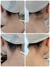 エステシェービングサロン フルール(Fleur)/うなじのビフォーアフター