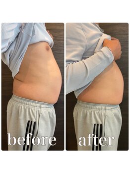 ファビー(Fabby)/マグフォース1回のビフォアフ