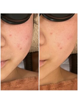 アルカディア(Arcadia)/顔脱毛/ビフォーアフター