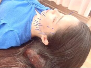 なかの鍼灸整骨院 用勺院の写真/【温灸美容鍼】女性人気No.1の美容鍼灸施術!この時期気になる乾燥肌・シワ・くすみ・たるみを徹底ケア♪