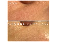 リメンテ 大阪南森町(REMENTE)の雰囲気（毛穴の開きや黒ずみ、ニキビケアなどお悩みに合わせて施術します）