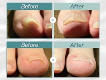 巻き爪研究所 表参道院/巻き爪ビフォーアフター