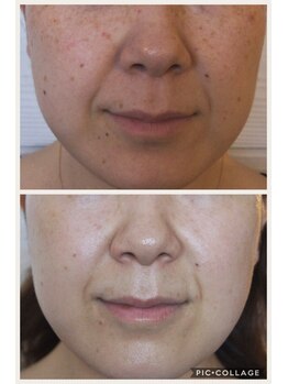 ザ シー タイムレスビューティ(THE SHE)/40代お客様症例写真