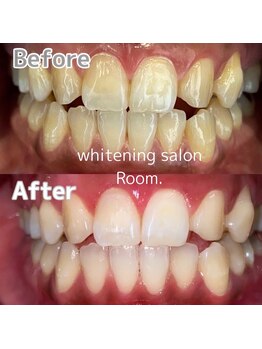 ルーム(Room.)/ホワイトニングで白い歯へ導く♪