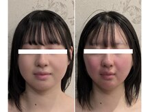 チャング ユー(CHANG YOU)の雰囲気（小顔骨気メニューのビフォー→アフター）
