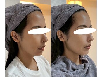 マザートウキョウ(Mother TOKYO)/小顔・中顔面短縮☆